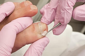 Ingrown toenails treatment in the Midtown Manhattan, New York, NY 10036 area